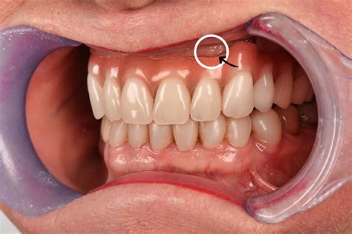 Day 3 After Immediate Dentures: Unlocking Comfort And Confidence